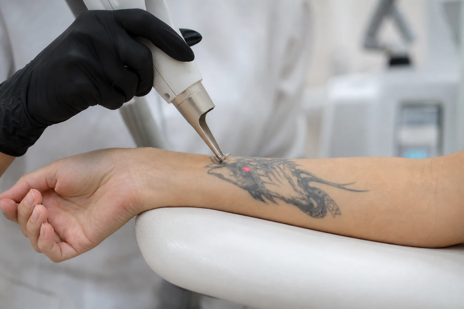 Hvordan fungerer fjerning av tatovering med laser?